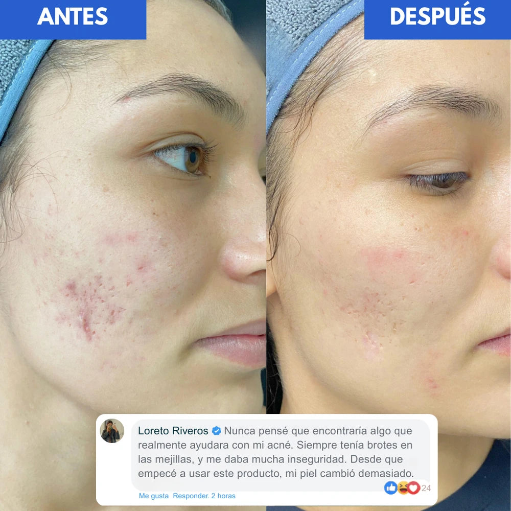 Loción Antiacne Dr Leo