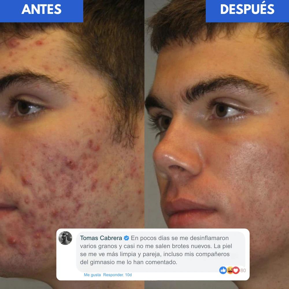 Loción Antiacne Dr Leo
