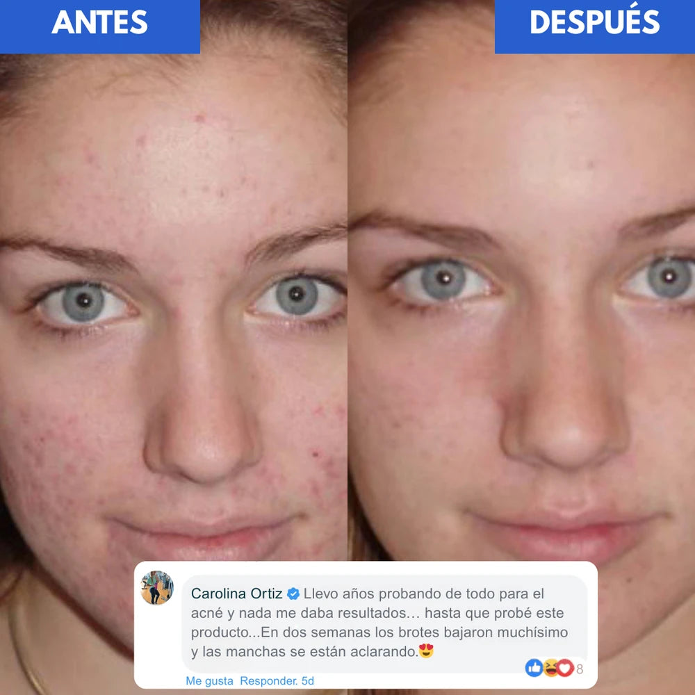 Loción Antiacne Dr Leo