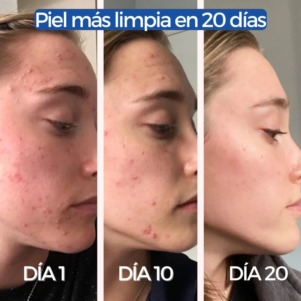 Loción Antiacne Dr Leo